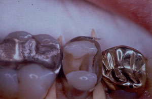 Posterior Restauration Procedure