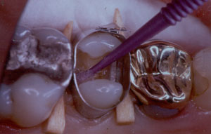 Posterior Restauration Procedure