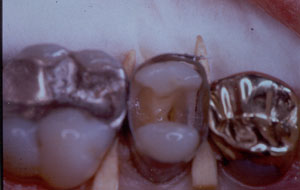 Posterior Restauration Procedure