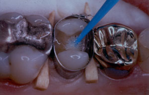 Posterior Restauration Procedure