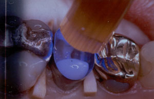 Posterior Restauration Procedure