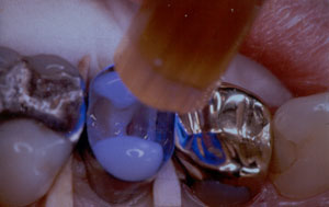 Posterior Restauration Procedure