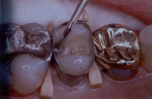 Posterior Restauration Procedure