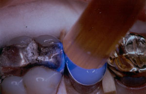 Posterior Restauration Procedure