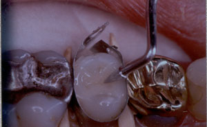 Posterior Restauration Procedure