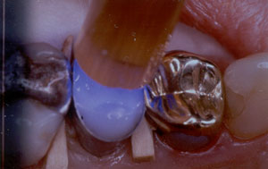 Posterior Restauration Procedure