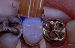 Posterior Restauration Procedure