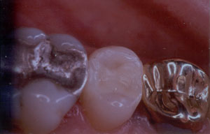 Posterior Restauration Procedure