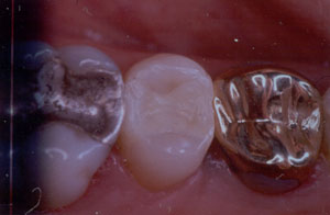 Posterior Restauration Procedure