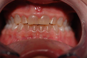 Dentinogenesis Imperfecta