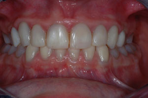 Dentinogenesis Imperfecta