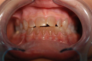 Dentinogenesis Imperfecta