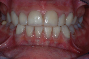 Dentinogenesis Imperfecta