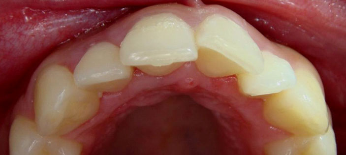 Correction of position (veneers)
