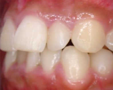 Correction of position (veneers)