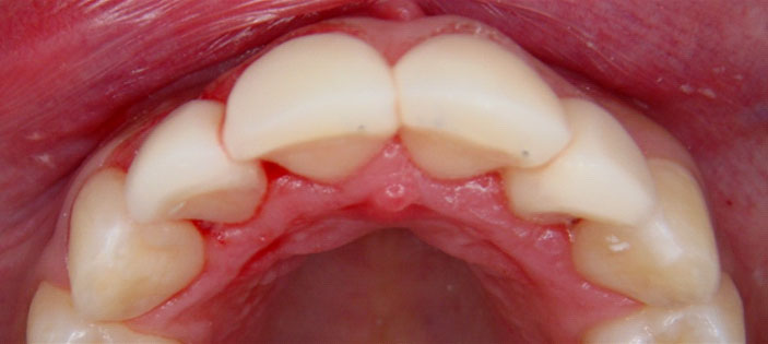 Correction of position (veneers)