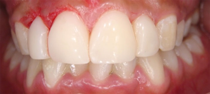 Correction of position (veneers)