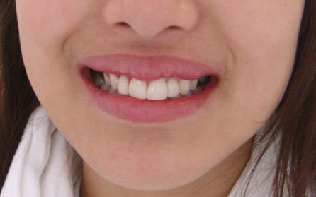 Correction of position (veneers)