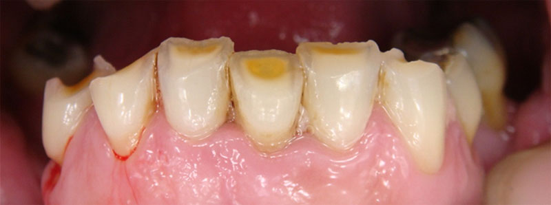 Severe abrasion
