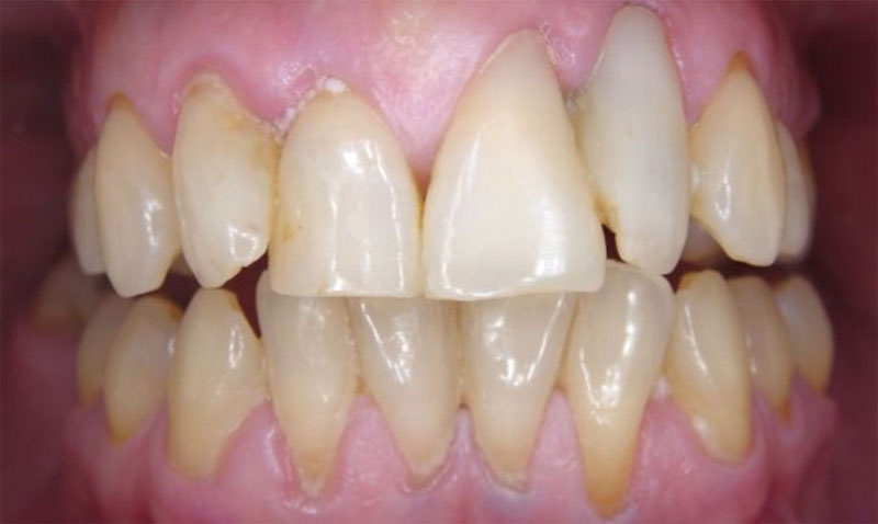 Replacement of facings (1)