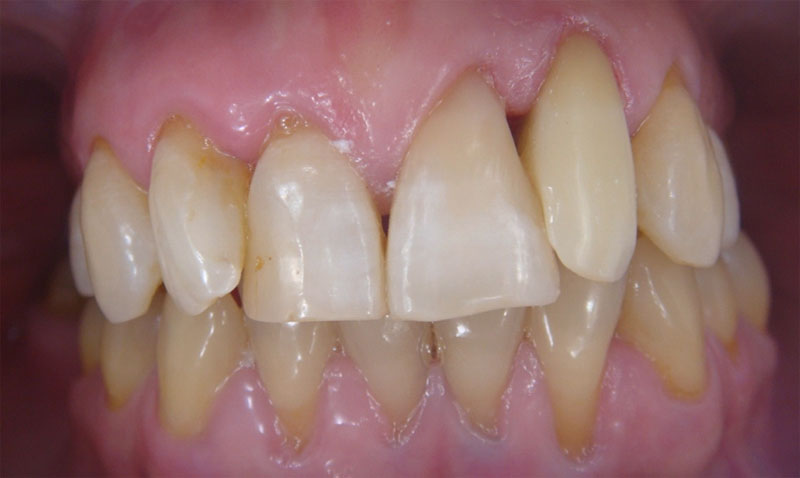 Replacement of facings (1)