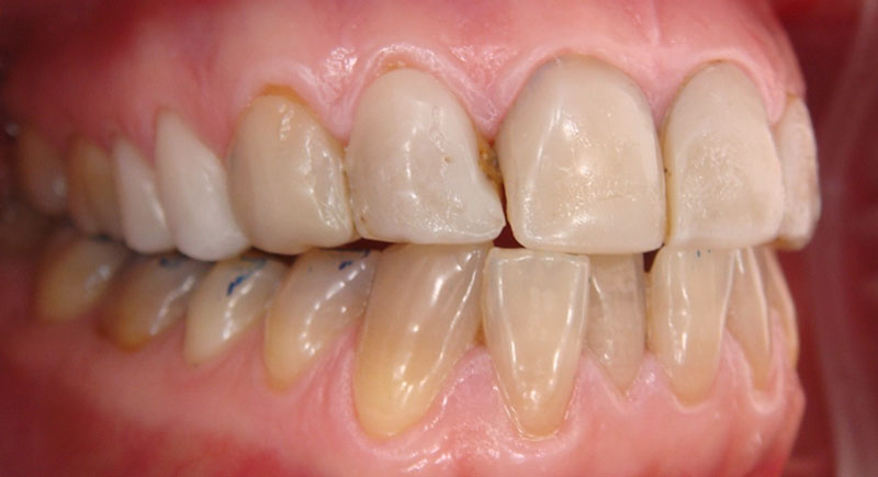 Replacement of facings (2)