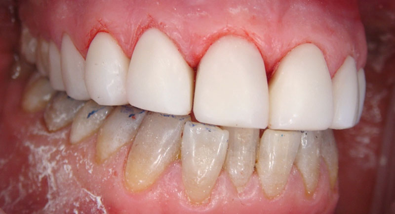 Replacement of facings (2)