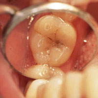 anterior restoration
