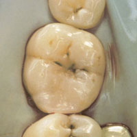 anterior restoration