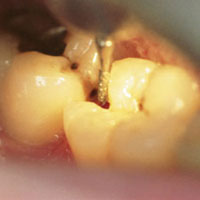 anterior restoration