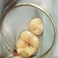 anterior restoration