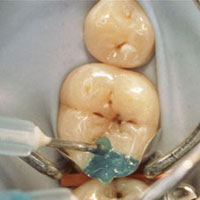 anterior restoration