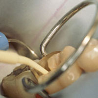 anterior restoration
