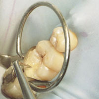 anterior restoration