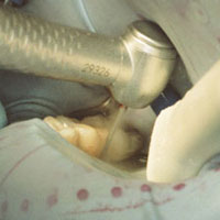 anterior restoration