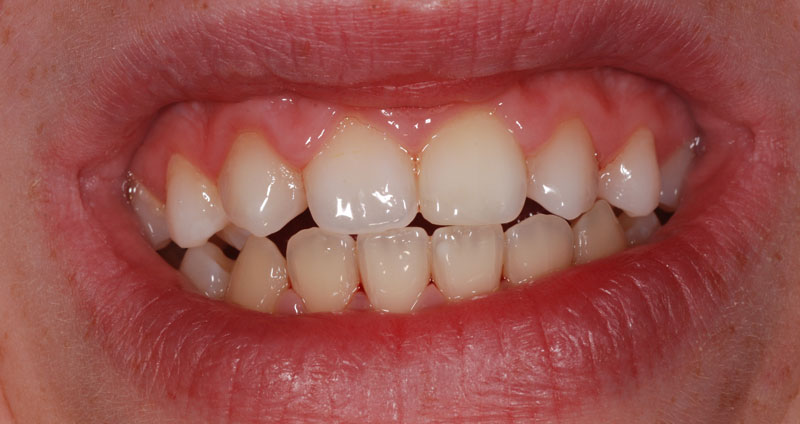 extension lateral incisive