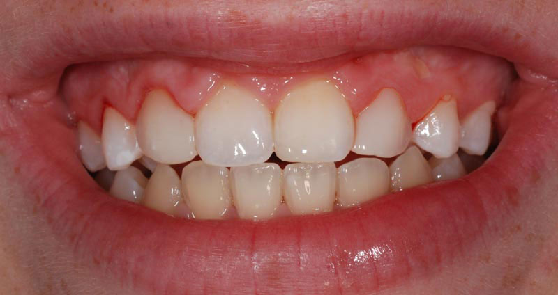 extension lateral incisive