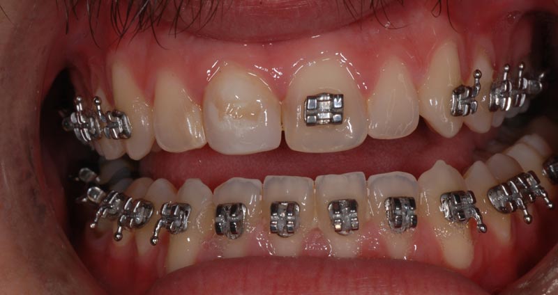 damaged incisor
