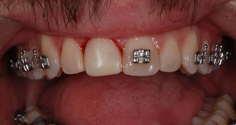 damaged incisor