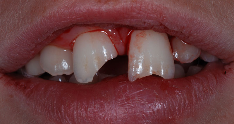 severe fracture