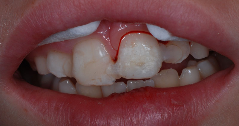 severe fracture