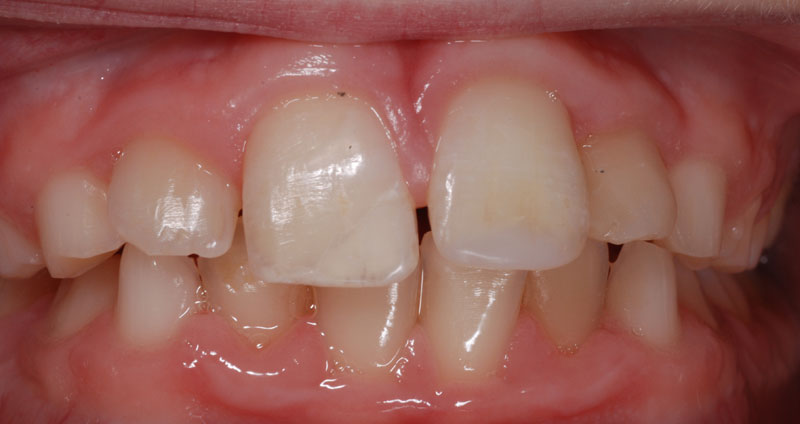 severe fracture