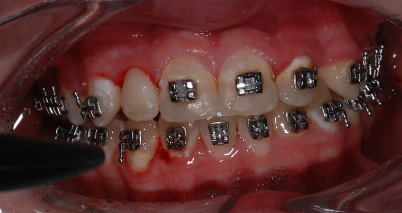 ortho treatment