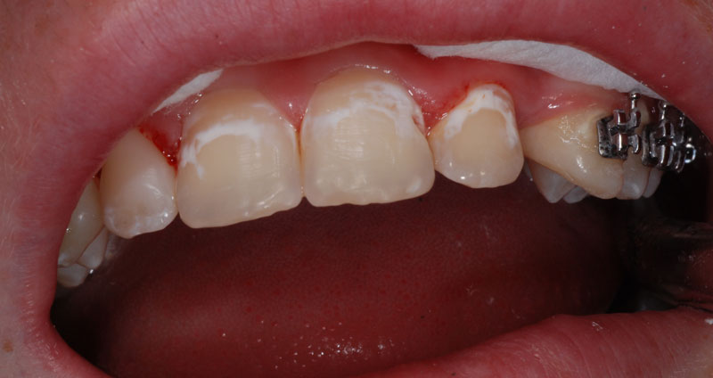 ortho treatment