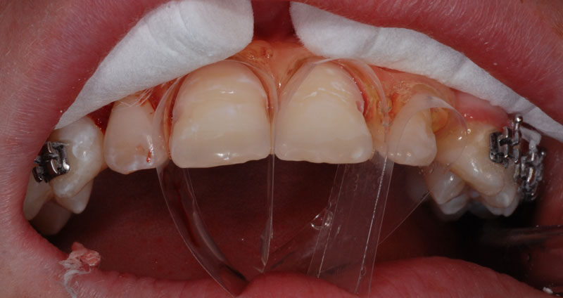 ortho treatment