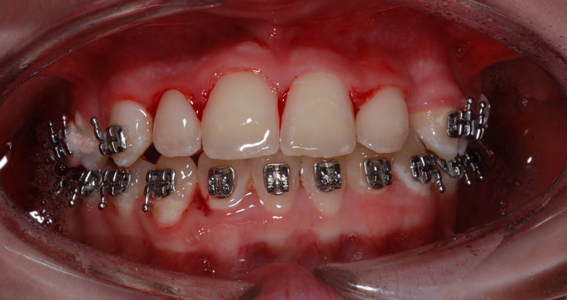 ortho treatment