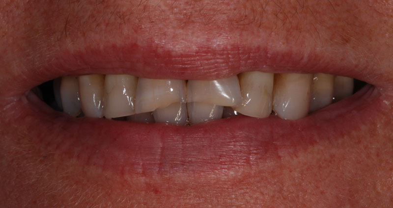 restore length