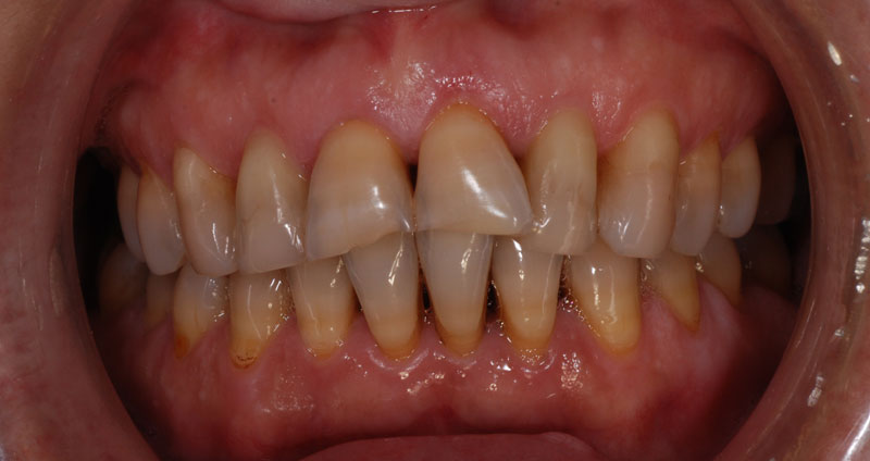 restore length
