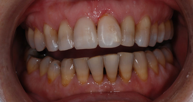 restore length