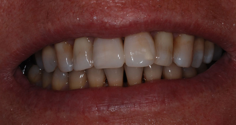 restore length